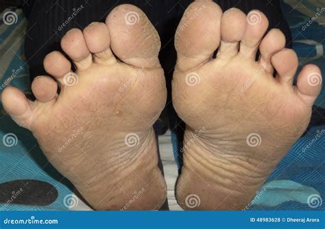Six Fingers In Both Feet Stock Photo Image Of Foot Fingers 48983628