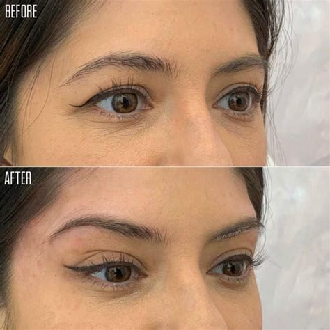 Snatched Beauty 🤩 Non Surgical Brow Lift Using Pdo Threads Only 🧵