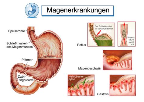 Magenprobleme kann eine Gastritis Magenschleimhautentzündung sein