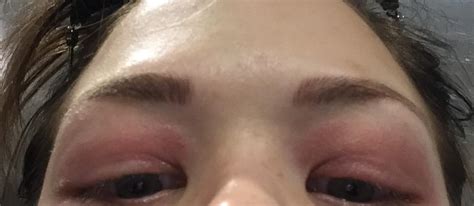 Skin Concern At My Wits End What Is Wrong With My Eyelids Allergy