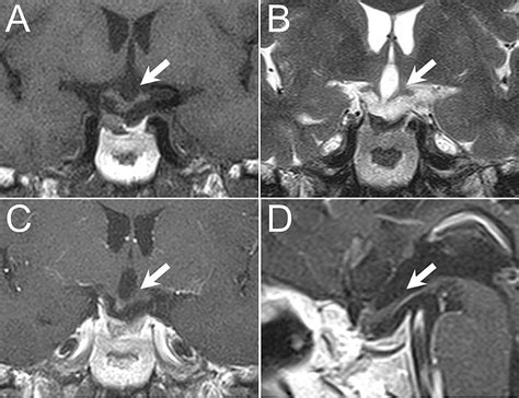 Primary Choroid Plexus Papilloma Over Sellar Region Mimicking With