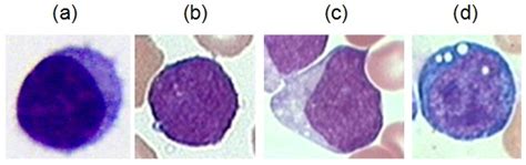 All Idb Acute Lymphoblastic Leukemia Image Database For Image Processing