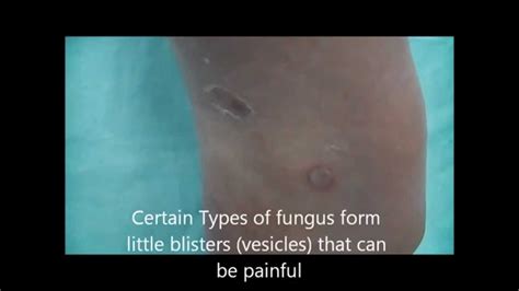 Fungal Foot Infection Tinea Pedis Youtube
