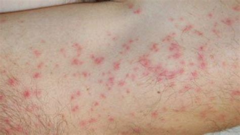 Coq Menstruation En Conséquence Small Red Spots On Skin Marque