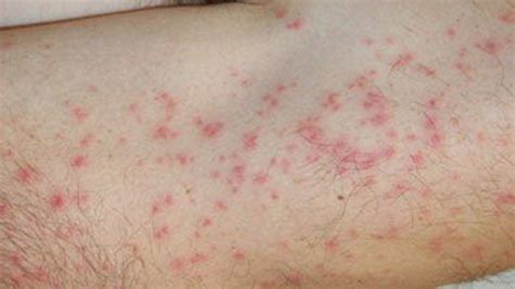 Small Red Spots On Skin Not Itchy Tiny Dots Bumps Pinpointed Rezfoods