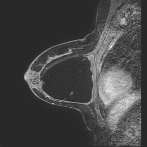 Intracapsular Breast Implant Rupture Image
