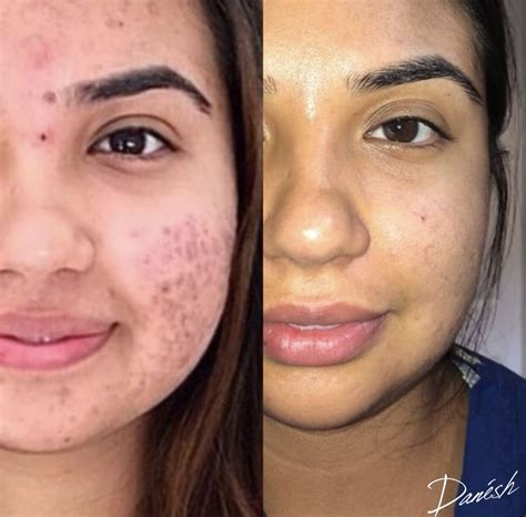 Before And After Photos Acne Hair Removal Botox And More — Danesh