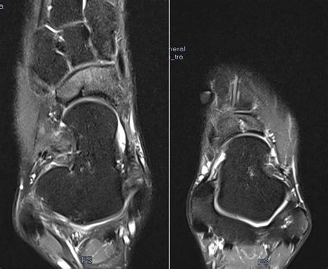 Mri Showing Bilateral Navicular Stress Fractures Download Scientific
