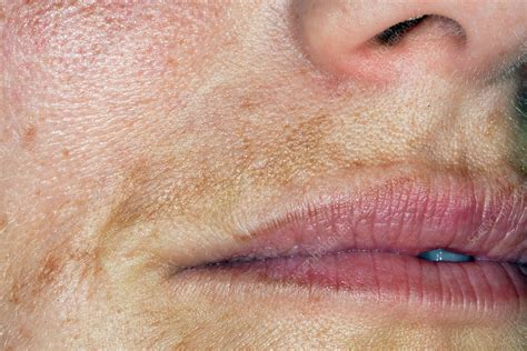 Melasma Of The Face Stock Image C0263343 Science Photo Library