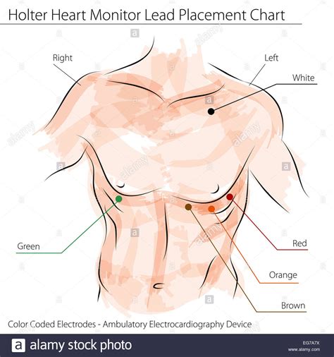 An Image Of A Holter Heart Monitor Lead Placement Chart