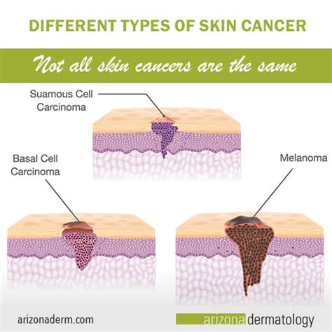 Skin Cancer Types Mowry Dermatology Surgical Dermatol