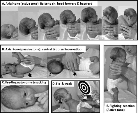 Neurological Assessment Of Preterm Infants For Predicting Neuromotor Status At 2 Years Results
