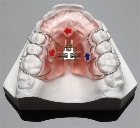 3 Way Palatal Expanderorthodontic Expansion Appliance China 3 Way