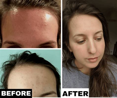 How I Cleared My Tiny Bumps On Forehead Once And For All