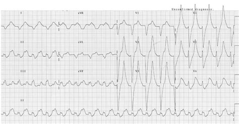 Ecg In A Patient With A Serum K Of 93 Meql It Shows Peaked T Waves