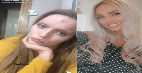Former Drug Addict Shares Incredible Before And After Photos After She