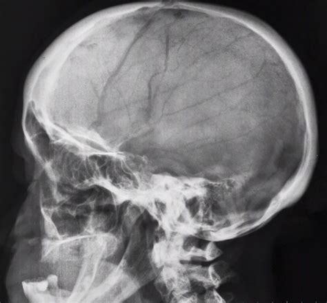 Normal Lateral Skull Radiograph Buyxraysonline
