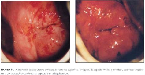 La Colposcopia Y El Tratamiento De La Neoplasia Intraepitelial Cervical