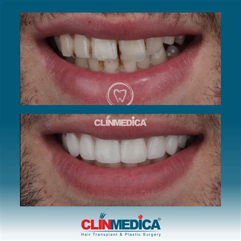 Cosmetic Dentistry Before After In Turkey Clinmedica Istanbul
