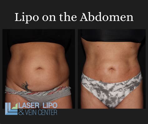 Liposuction Before After St Louis Lipo