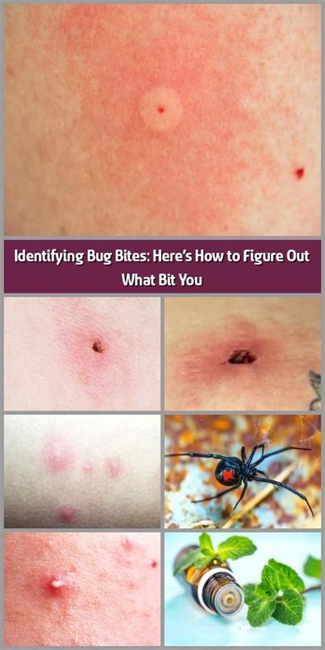 Bug Bites That Look Like Mosquito Bites But Aren T All Three Of These Insects Belong To The Same