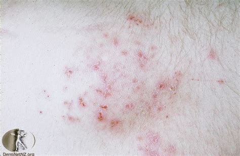 Dermatitis Herpetiformis Tæt På Patienthåndbogen På Sundheddk
