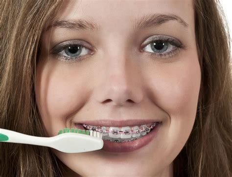 Now a day, it's getting easier to clean teeth with braces because of the availability of various tools or braces kits. Keeping Your Braces Clean - Dental Care Orthodontics