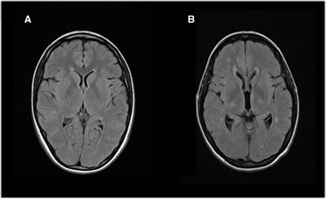 Thalamic Atrophy In A Recent Diagnosis Of Primary Progressive Ms A
