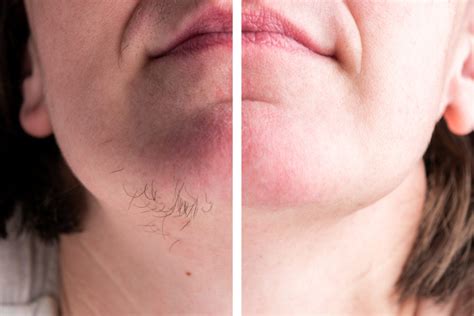 Your Options For Removing Those Annoying Chin Hairs Healthgist
