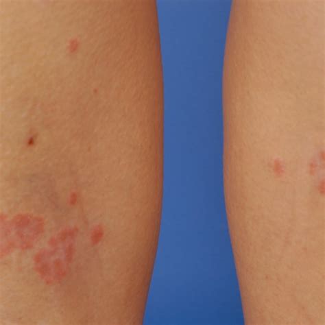 Scaly Erythematous Plaques Occurring On The Lower Extremity Months