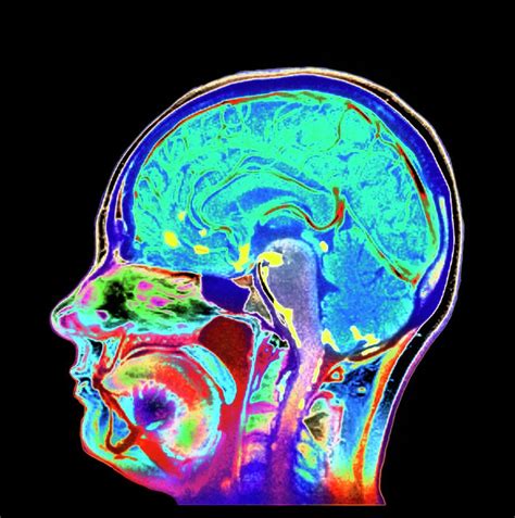 Meningitis Brain Scan Photograph By Simon Fraser Newcastle Hospitals