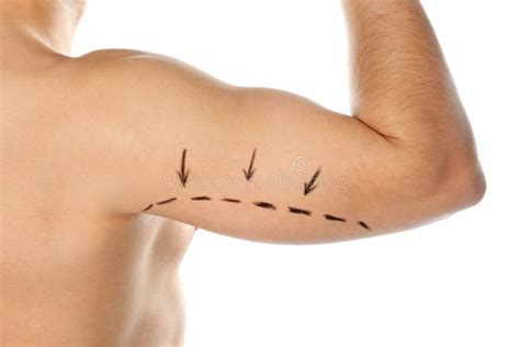 Young Man With Marks On Arm For Cosmetic Surgery Operation Against