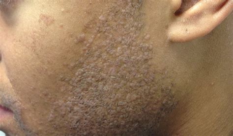 Derm Dx Pink Flat Papules On The Face Clinical Advisor