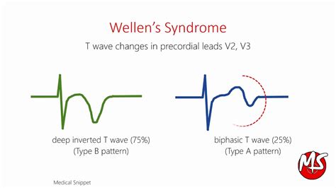 Wellens Syndrome With Ecg And Angiography Example Youtube