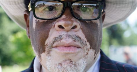 Photographer Jasmine Colgan Captures The Faces Of People With Vitiligo