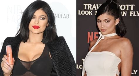 Kylie Jenners Plastic Surgery Face Before And After Photos
