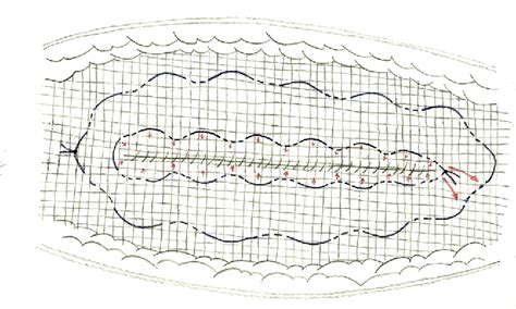 Figure 2 From New System Of Mesh Fixation For „onlay Hernia Repair