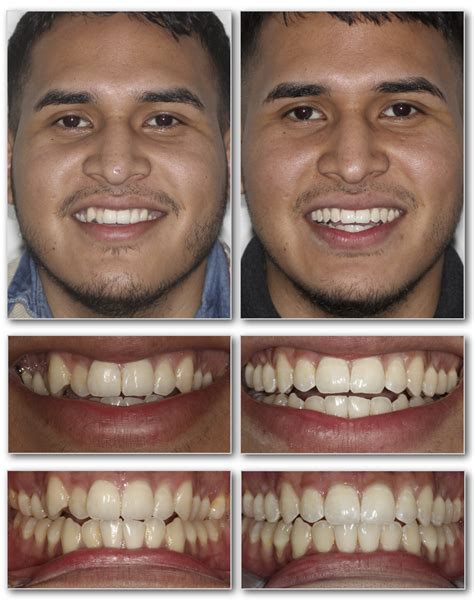 Invisalign Before And After — Invisalign Studio