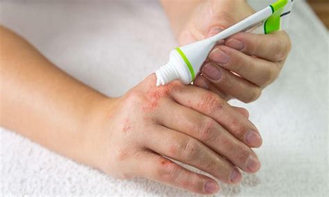 Pin On Skin Care Eczema