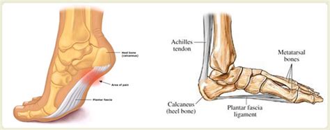 Plantar Fasciitis The Hartland Podiatry Clinic