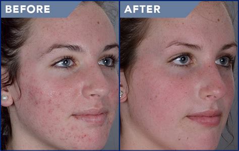 Acne Treatment Before After