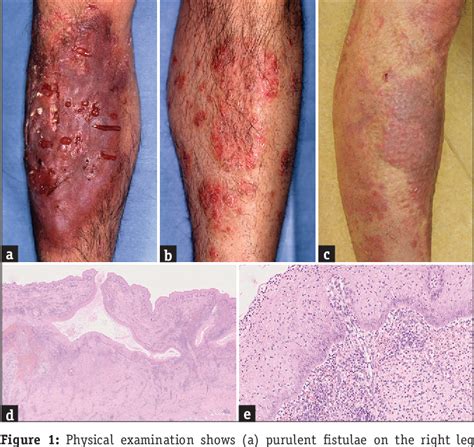 Figure 1 From Atypical Hidradenitis Suppurativa On The Leg In A