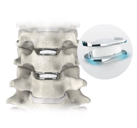 Artificial Disc Replacement An Alternative To Spinal Fusion Remi