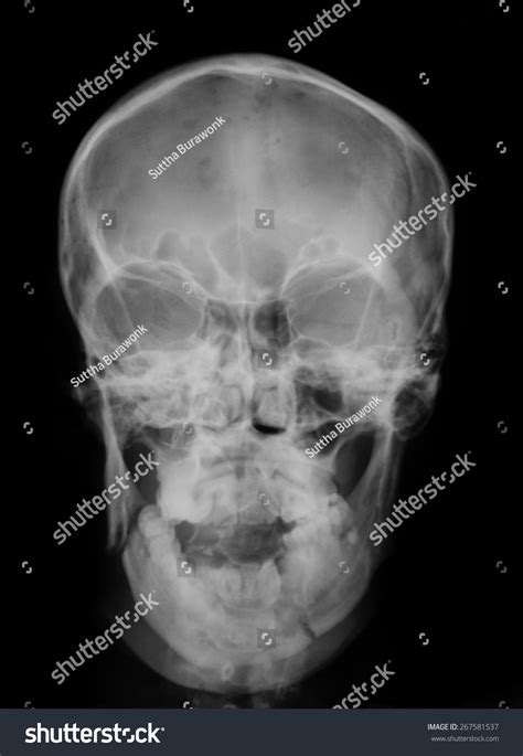 In medical imaging terms, these are images that have values ranging from 0 to dentistry lectures for mfds/mjdf/nbde/ore: Xray Image Broken Skull Ap View Stock Photo 267581537 ...