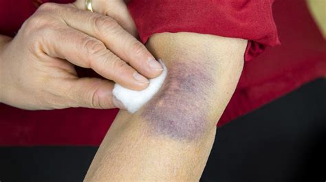 How To Avoid And Treat Big Bruises On Paper Thin Skin Starts At 60