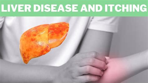 Liver Disease And Itching Why Do Your Skin Itch When You Have Liver