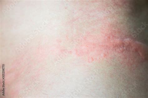 Urticaria On Skin Rashes Of Which Urticaria And Toxic Erythema Are