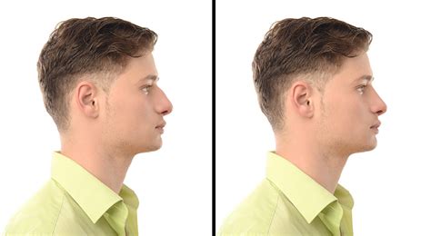 rhinoplasty in dublin oh ohio facial plastics