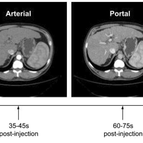 Demonstration Of The Contrast Phases Of A Liver Ct Scan Download