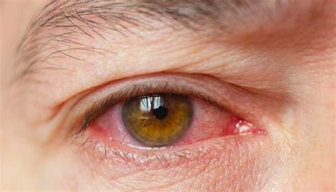 Is Pink Eye A Symptom Of Covid 19